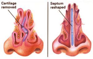 Septoplasty & Turbinate Surgery | Dr. Michael J PaciorekDr. Michael J Paciorek