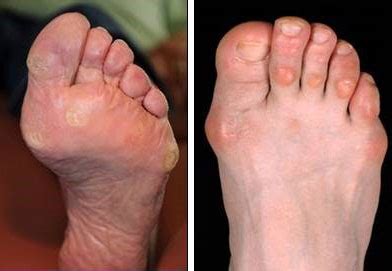 Corns & Callus | What Are They & How Can They Be Treated? | FootSmart Podiatry