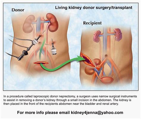 kidney for jenna - living donors are making a difference! | Kidney transplant, Kidney donor ...