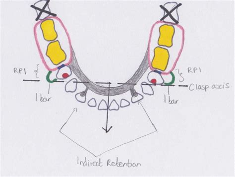 Rpd Design Drawing - Design Talk