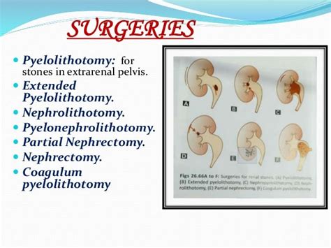 Stones & tumours of kidney ppt.- by Smriti singh