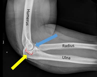 Ulna Hairline Fracture