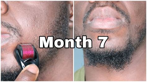 Dermaroller Before And After Beard - The first thing to consider is your condition. - Goimages Talk