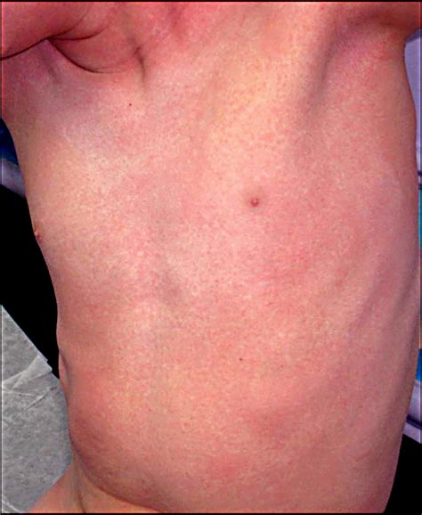 Numbered Diseases of Childhood: Rashes