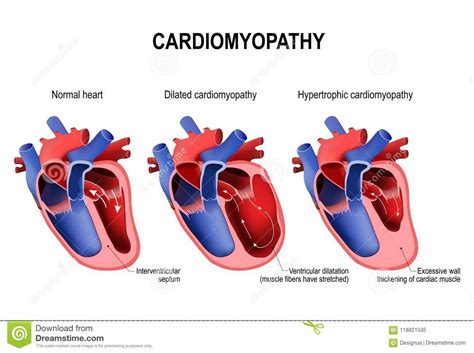 Hypertrophic cardiomyopathy, dilated cardiomyopathy and healthy ...