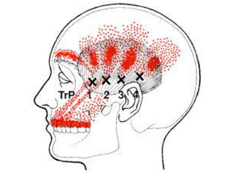 Temporal Headaches | Symptoms, Causes, Treatments