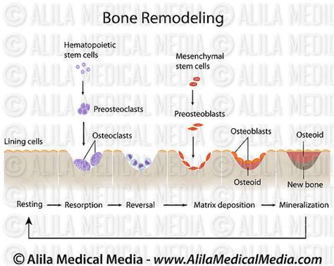 Alila Medical Media | Bone remodeling labeled diagram. | Medical illustration