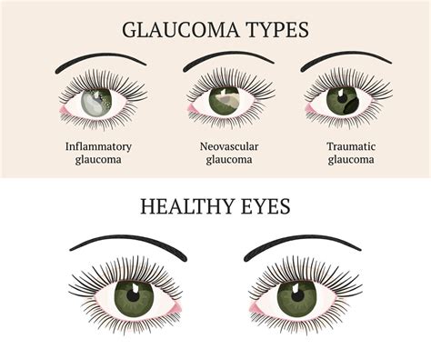 Glaucoma Chart | Accent Eye Care