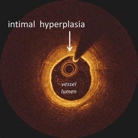 Image of intimal hyperplasia | Download Scientific Diagram