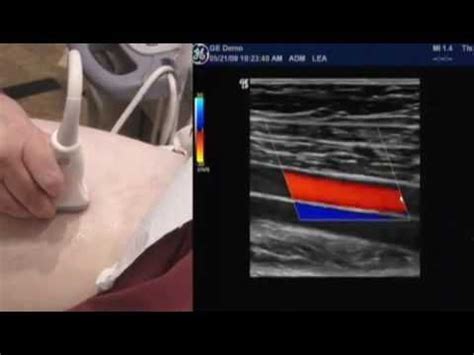 How To Lower Extremity Arterial Duplex Exam - YouTube | Ultrasound ...