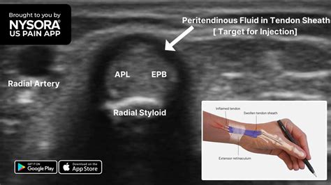 De Quervain’s Tenosynovitis - Injection