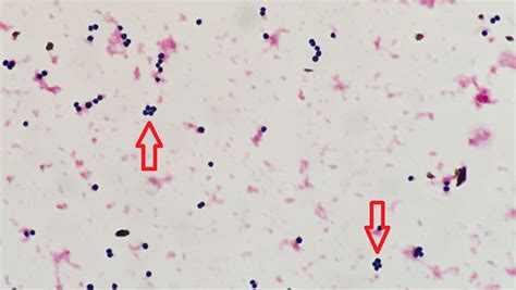 Aerococcus spp〔エーロコッカス〕 | グラム染色: Gram Stain