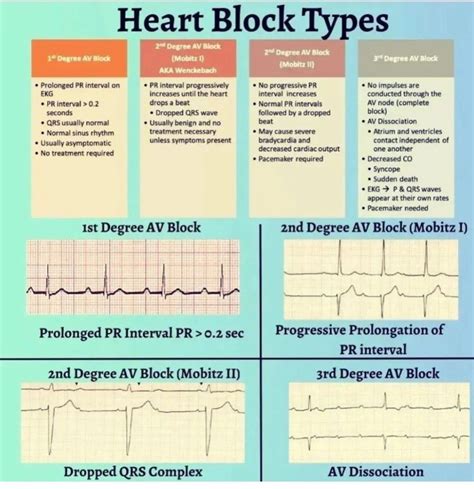 Heart Block Types - MEDizzy