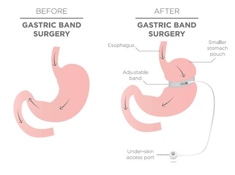 Managing patients with Obesity - The Surgical Weight Loss Centre