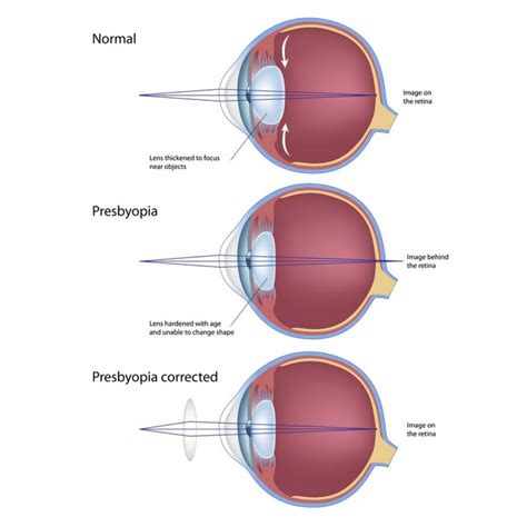 Presbyopia — Salle Opticians