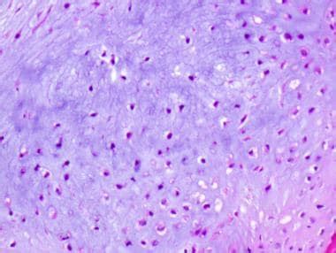 Enchondroma Pathology: Definition, Etiology, Location