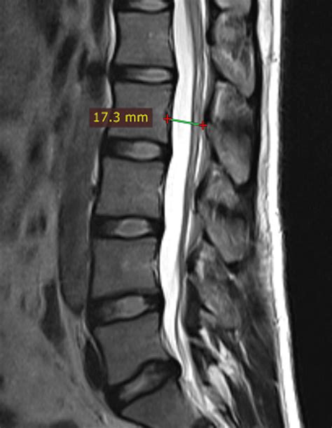 The MRI of Lumbar Vertebral Canal in Low Back Pain: A Cross-Sectional Study | Cureus