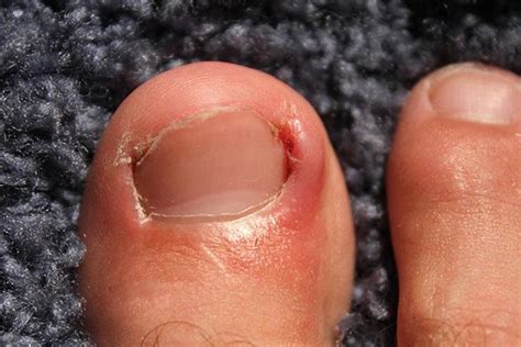 Ingrown Toenail In Children: 6 Causes And 7 Treatments