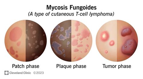 Leukemia Symptoms Skin