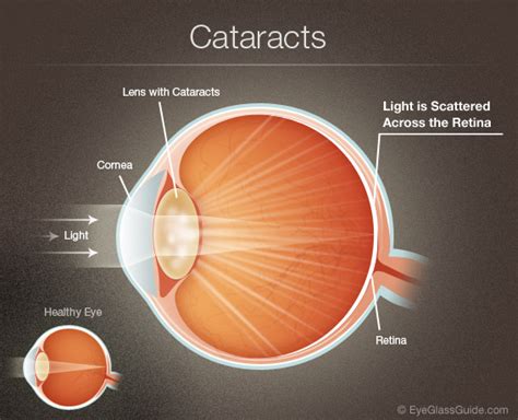 Back to basics - all about cataracts - Sydney Ophthalmic Specialists