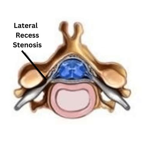 Spinal Stenosis Of Neck Symptoms (Cervical Spinal Stenosis)