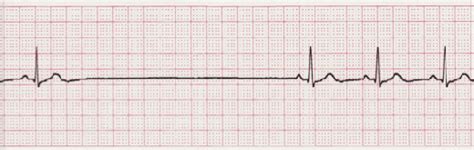 Sinus Arrest - EKG Lesson #313