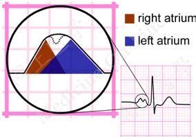 ECG - P wave morphology - LITFL ECG Library | P wave, Ekg rhythms ...