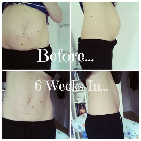 Diastasis Recti - CarrieFit | Diastasis, Diastasis recti, Flat belly