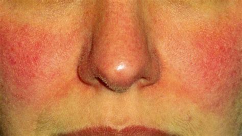 New Study Links Rosacea & Chronic Systemic Diseases | Rosacea.org