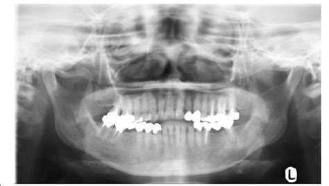 A panoramic radiograph showing a loss of the lamina dura and a... | Download Scientific Diagram