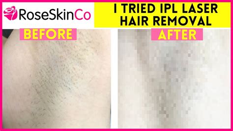 IPL LASER HAIR REMOVAL | 12 WEEK UPDATE (BEFORE & AFTER) - YouTube