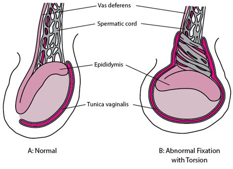 Testicular Torsion - Genitourinary Disorders - Merck Manuals Professional Edition