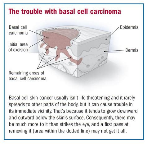 Basal Cell Carcinoma Utah County | Dr. David Myers