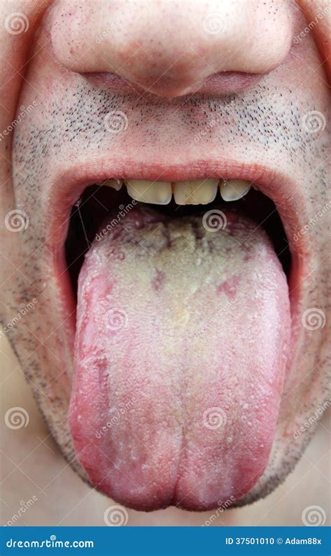 Disease tongue stock photo. Image of cavity, mouth, inflammatory - 37501010