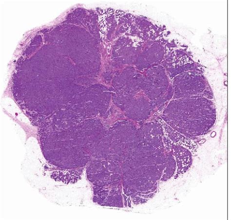 Invasive Lobular Carcinoma Variants | Basicmedical Key