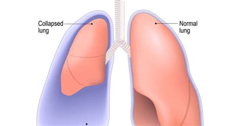 Pulmonary Bleb