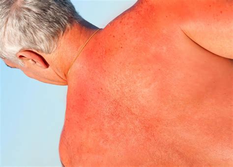 What Are the Signs of a Sunscreen Allergy? (with pictures)