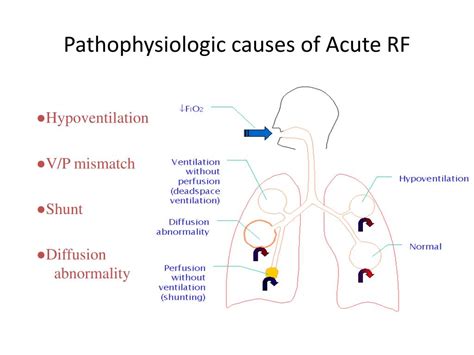 Respiratory Failure