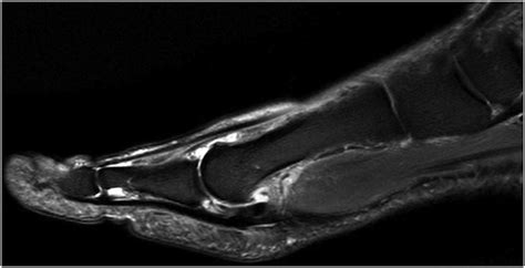 Hallux valgus assessment on X-ray and Magnetic resonance Imaging (MRI): Correlation with ...