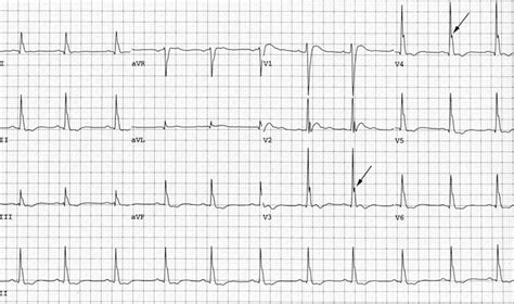 Hypercalcaemia ECG changes • LITFL • ECG Library