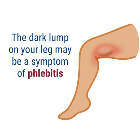 What is Phlebitis? - Delaware Vein Center