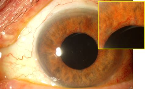 Glaucoma Information Secondary glaucoma - Can diabetes cause glaucoma? Neovascular glaucoma ...