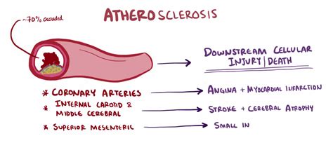 Atherosclerosis Treatment - Alternative Therapy