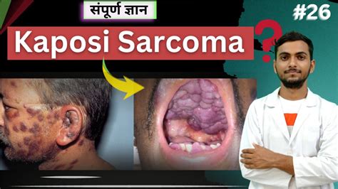 "Understanding Kaposi Sarcoma: Symptoms, Causes, and Treatment" #cancer ...