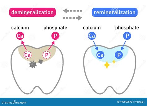 Diagram of Tooth Demineralization and Remineralization. Dental Care Concept Stock Vector ...