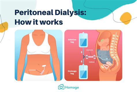 A Complete Guide to Peritoneal Dialysis in Singapore - Homage