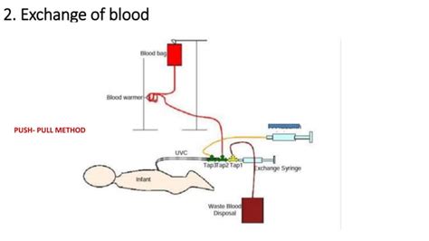 Exchange transfusion