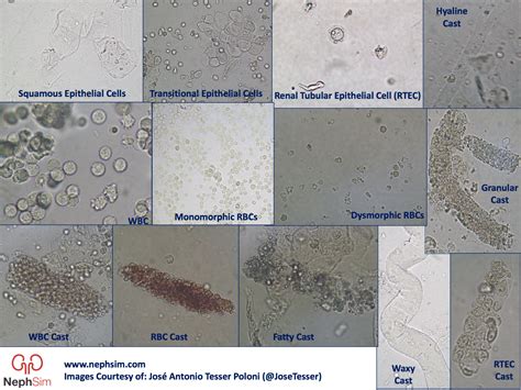 Hyaline Casts In Urine / Microscopic Analysis of Urine | Faculty of Medicine ... - The presence ...