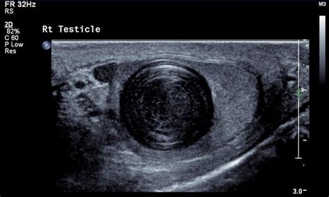 Intratesticular epidermoid cyst - here is a well circumscribed intratesticular mass at the upper ...