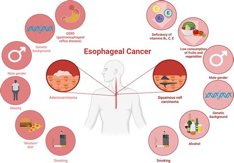 Esophageal Cancer Symptoms, Causes, Complications, 44% OFF